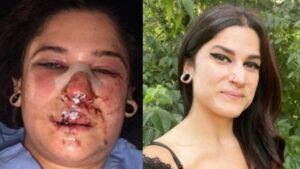 Chaney Crabb, chanteuse du groupe Entheos, partage une photo de son terrible accident de scooter de 2021 avec un message inspirant